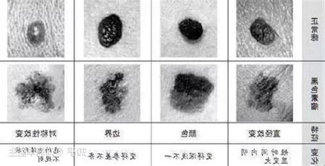 陰莖 黑痣